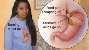 Acupuncture for Gastroesophageal reflux disease